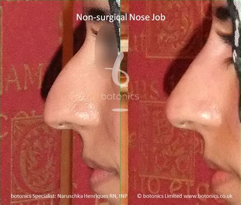 Despite its popularity, it's not suitable for everyone, and here's all you need to know about the procedure. non-surgical nose enhancement. | Nose job, Nose surgery ...