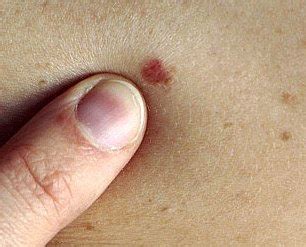 You can then show these pictures to your doctor. Pictures of skin cancer: Skin cancer early signs