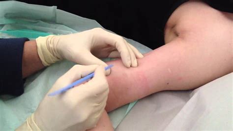 Unless you start another hormonal birth control method after removing the implant, your period will go back to how it was before you got nexplanon. Implant Implanon Removal - YouTube