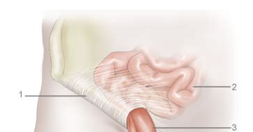 In a mesh hernia repair, the surgeon places a patch over the hernia and fixes it in place. Hernia