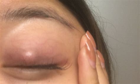Check spelling or type a new query. I've had a bump on my eyelid for over a week, is this ...