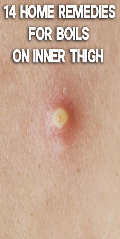 If you have a huge inner thigh boil, you do not have to worry; Pin on Home remedy for boils