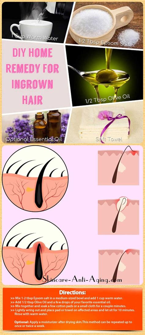 Often, an ingrown hair improves without treatment. Perfect DIY Home Remedy For Ingrown Hair Removal | Ingrown ...