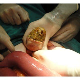 Bezoars usually form in the stomach, sometimes in the small intestine or, rarely, the large intestine. 61-year-old female patient. (a) CT findings: an ...