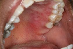 Understanding the two different types of the herpes simplex virus (hsv) is an important part of understanding herpes and its role in our society. How do I Manage a Patient with Recurrent Herpes Simplex ...