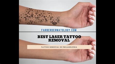 Ringpfeil advanced dermatology provides laser tatto removal with picosure, which removes tattoo in fewer treatments, less damage to the skin and in a lower cost in philadelphia pa. Laser Tattoo Removal Philadelphia & Main Line PA - Farber ...