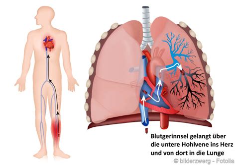 Groupe d'etude de la thrombose de bretagne occidentale. Thrombose Bein Symptome / Knieschmerzen seitlich von der ...