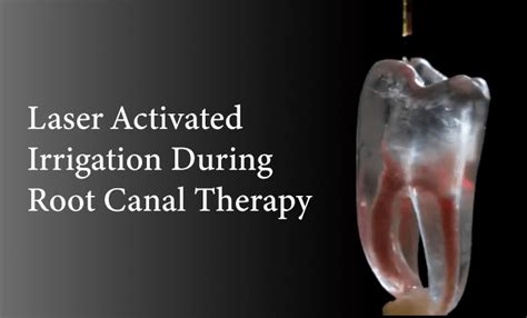 The only way to stop it is through retention. How To Kill A Tooth Nerve Without Root Canal