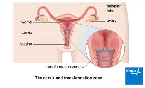 The infection of the cancerous tumor is what causes unpleasant smelling discharge. Cervical cancer | Health Information | Bupa UK