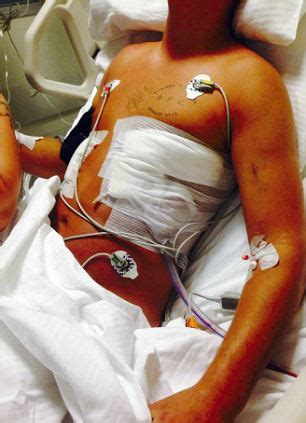 It was nearly flat before i went in for surgery, and now it is bloated and pudgy looking again. British man 'ambushed by 15 locals' and stabbed with ...