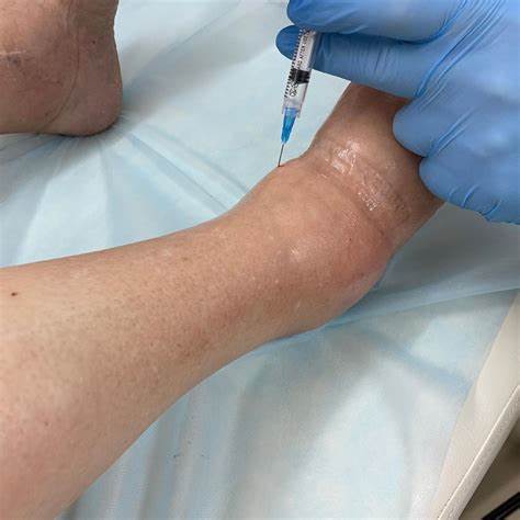 Артроз голеностопного сустава диета Пункция голеностопного сустава - Медцентр "Диагност" Пункция голеностопного сустава - Медцентр "Диагност" Артроз голеностопного сустава диета