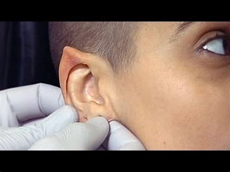 Expect to pay around $600 to $1,000 for elf ear surgery price when done by someone who is not a licensed doctor or surgeon. Elf Ear surgery the new fad in body modification - YouTube