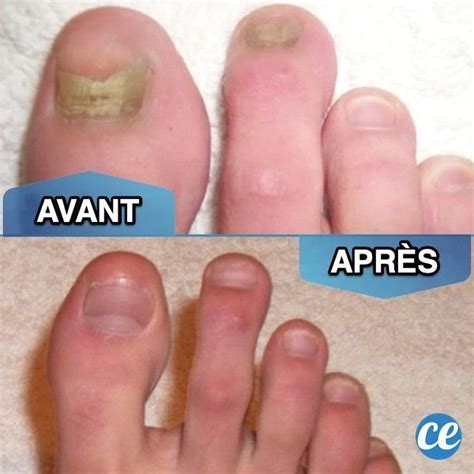 Voici un traitement naturel pour la mycose des ongles de pieds ou de ...