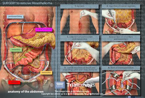 Webmd's abdomen anatomy page provides a detailed image and definition of the abdomen. Surgery to Remove Mesothelioma - TrialExhibits Inc.