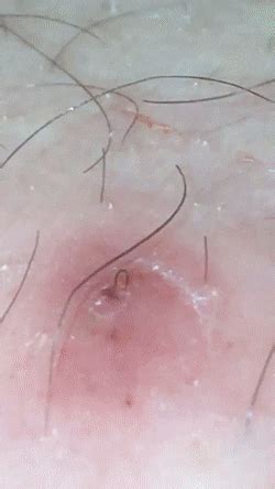 Ingrown hairs occur when hair grows back into the skin and causes red and itchy bumps. Pulling out a stubborn infected hair follicle. : popping