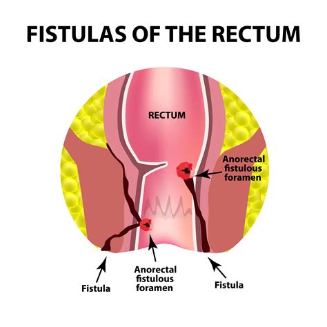 We did not find results for: Rectal Fistula: Symptoms, Diagnosis, and Treatment ...