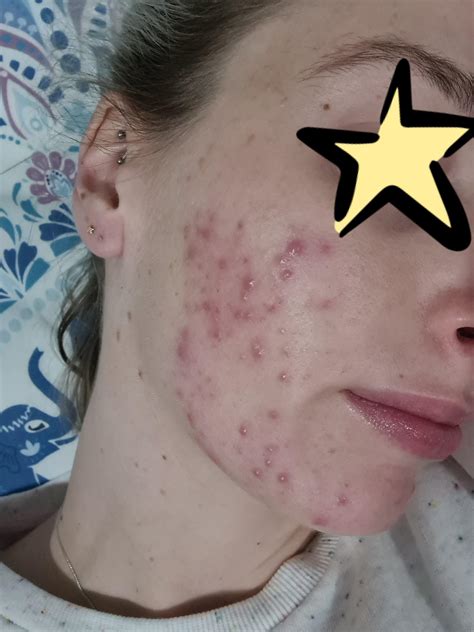 So here's the good news about acne purging—it's temporary! Before and after 4 months of accutane 🙂🙂 : Accutane