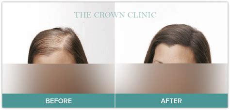 This gives the hair an unhealthy thin appearance), and patterns of balding the scalp. Hair Loss Medication Sydney | The Crown Clinic