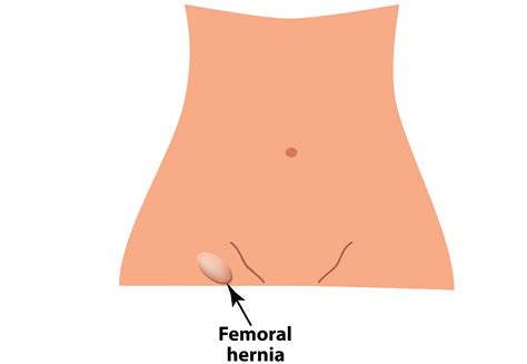 Femoral hernias are more common in women than in men. Hernia: Is Surgery The Only Option? | Add More to Life - Meril