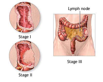 It is now generally accepted that the accumulation of somatic mutations and epigenetic defects drives the initiation and progression of tumor development. Early stage colon cancer and gatekeeper gene from ...