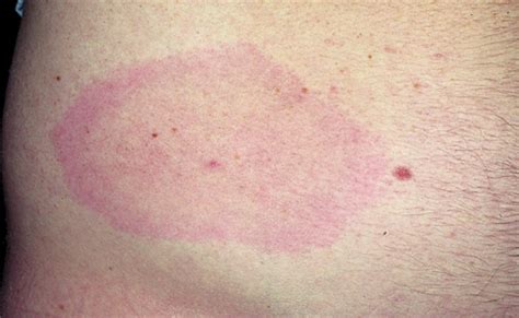 The red rash, also known as the 'erythema migrans' (em), is one of the most famous symptoms of lyme disease. The characteristic bullseye rash for Lyme disease | Innatoss