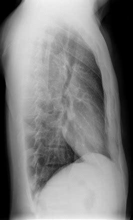 Consult a doctor for medical advice. Pectus excavatum | Image | Radiopaedia.org