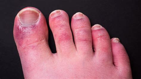 Symptoms can include fever, cough and shortness of breath. COVID Toes Could Last for 150 Days, New Research Finds ...
