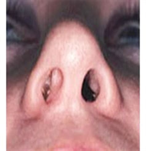 Nasal polyps (small growths/swellings in the nasal passage), nasal bone spurs, or other abnormalities such as a deviated septum or cleft palate. How Does A Deviated Septum Cause A Nosebleed? | Fauquier ...