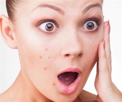 Microneedling offers fairly immediate results. Are you suffering from 'Isolation skin'? | Tia Brown ...