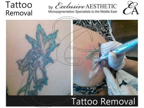 The resultant particle is large enough to be ejected by the skins natural healing process. Tattoo Removal for Body Art Tattoos, Rejuvi Tattoo Removal ...