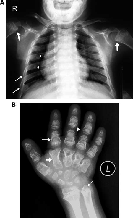 What does it mean by this findings: Chest and hand radiographs of cases 1 and 2. (A) Chest ...