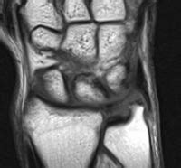 Discus triangularis oder discus articularis ulnocarpalis) ist beim menschen eine dreieckig geformte, aus faserknorpel bestehende zwischengelenksscheibe am handgelenk. Arztinfo / Magnetresonanztomographie / Klinische ...