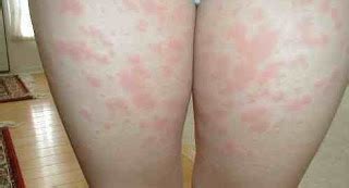 An infected person with sores present has an increased risk that exposure to hiv will lead to infection because the sores provide an entry point for the aids virus. Rash on Inner Thigh - Causes, Remedies and Treatment