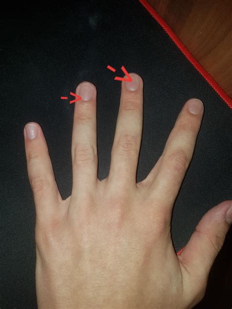 Oft sind die knubbel und verhärtungen harmlos. Wann wächst die Nagelhaut? (Hand, Nägel, Finger)