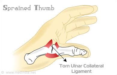 Our friendly customer care team is here to help you choose the right brace. Sprained Thumb - Symptoms, Treatment, Recovery, Prevention