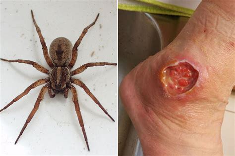 Watch a spider bite on a cat to make sure it doesn't fester and turn into a major wound. The worst spider bite pictures including the Brown Recluse ...