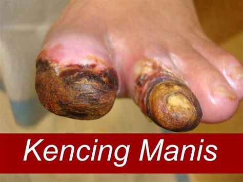 Oleh karena itu, untuk menegakkan diagnosis kencing manis, dokter tidak hanya bergantung pengobatan. 9 Tanda Kencing Manis Tidak Terkawal Dan Mungkin ...