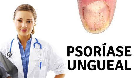 O primeiro, é a predisposição genética do paciente e a segunda são os. Psoriase Ungueal | Conheça o Melhor Tratamento Natural ...