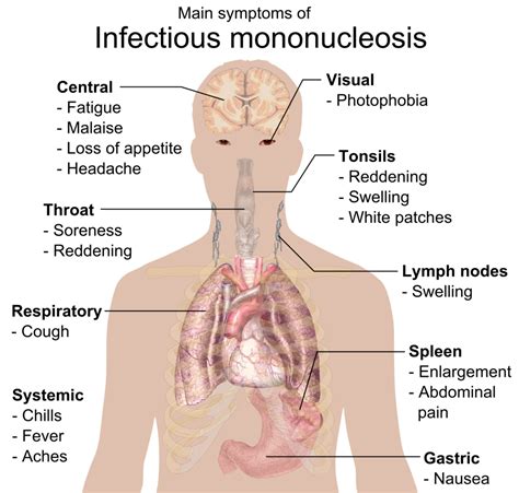 Kaye инфекционный мононуклеоз // справочники msd. File:Main symptoms of Infectious mononucleosis.png ...