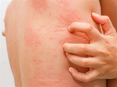 Hives, or urticaria, is a form of skin rash with red, raised, itchy bumps. Hives: 10 Symptoms of Hives