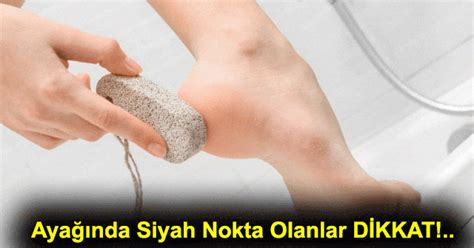 Ayakta kemik çıkıntısının tedavisi nasıl yapılır? Ayaktaki Siyah Noktalar Ve Siyah Lekeler Neden Olur, Nasıl ...