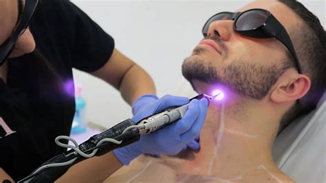 Real men with real hair who are not afraid to bare all! LASER HAIR REMOVAL FOR MEN | ALEX COSTA - YouTube