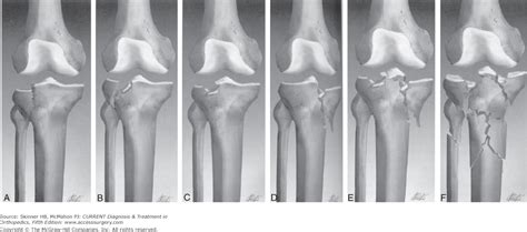 Examination for crohn's disease 2. Left Bicondylar Tibial Plateau Fracture Icd 10