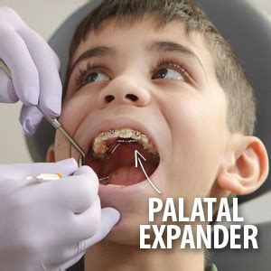 How palatal expander worksinna gellerman. The Timely Use of a Palatal Expander Could Help Correct a ...