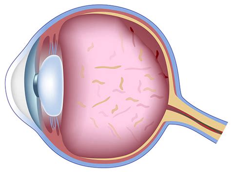 Retinal disorders affect this thin lining on the back of the eye. Services | Dr. Jeffrey L. Morrill & Assoc. | Franklin, MA