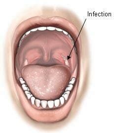 The average er visit cost for someone uninsured was $774 in 2018, compared to $1,372 for someone with private insurance. Tonsillectomy Adult - John Almeyda