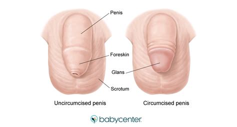A page for describing headscratchers: Circumcision in newborn boys | BabyCenter