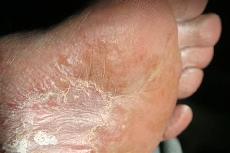 Maybe you would like to learn more about one of these? Obat Gatal Pada Telapak Tangan Dan Kaki Kulit Mengelupas ...