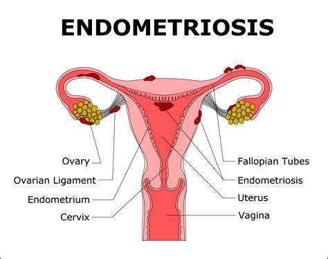 Treatments for endometriosis are drugs and surgery. Living with Endometriosis and how to make it your bitch ...