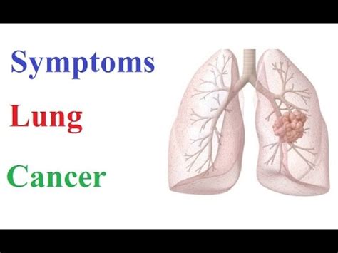 They begin to appear only once the disease reaches. Symptoms of Lung Cancer - YouTube
